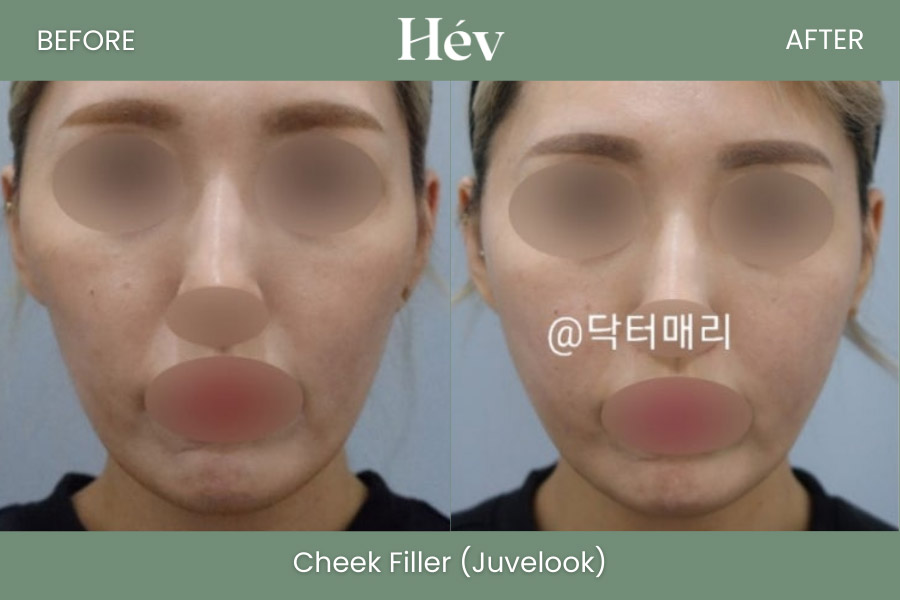 cheek-fille-juvelookr-before and after