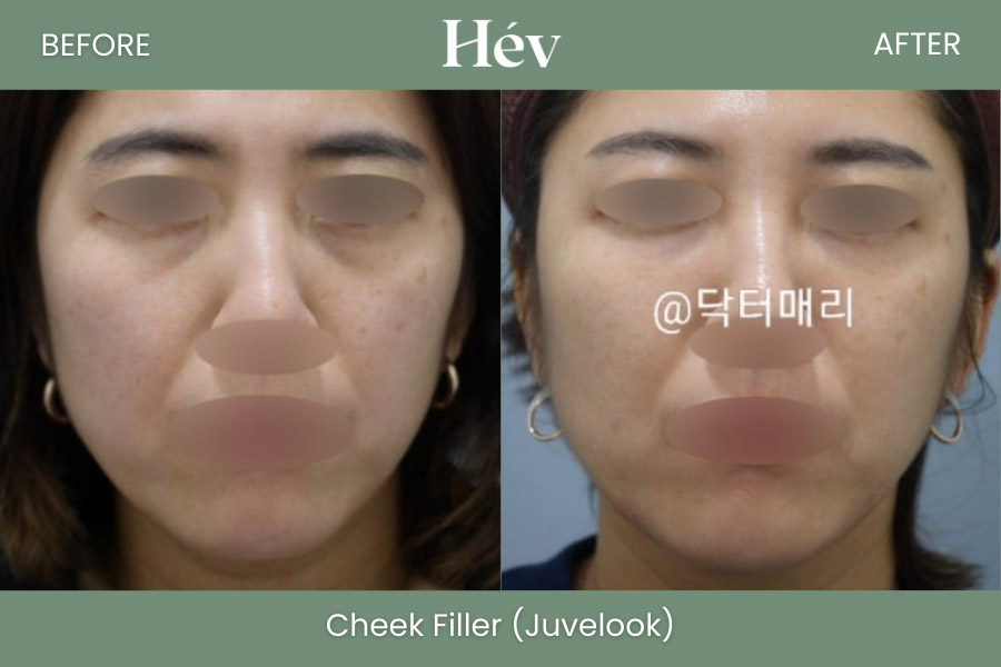 cheek-fille-juvelookr-before and after