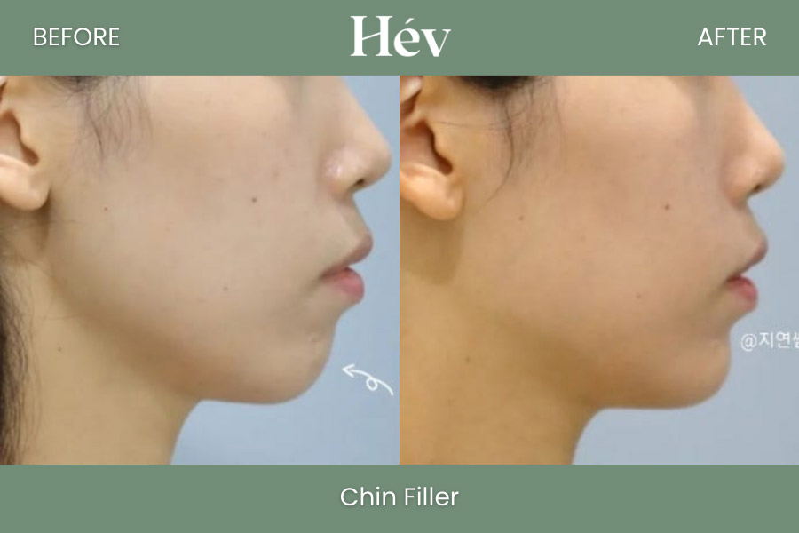 chin-filler before and after
