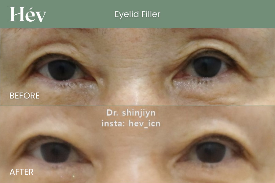 eyelid-filler before and after