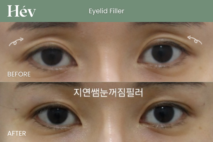 eyelid-filler before and after