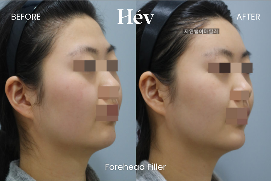 forehead filler before and after