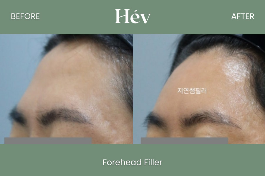 forehead filler before and after