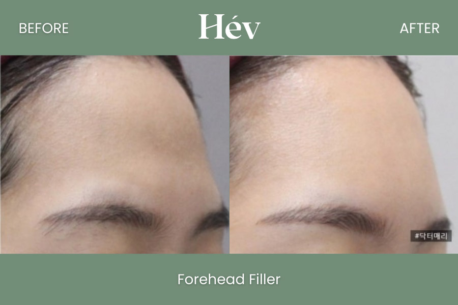 forehead filler before and after