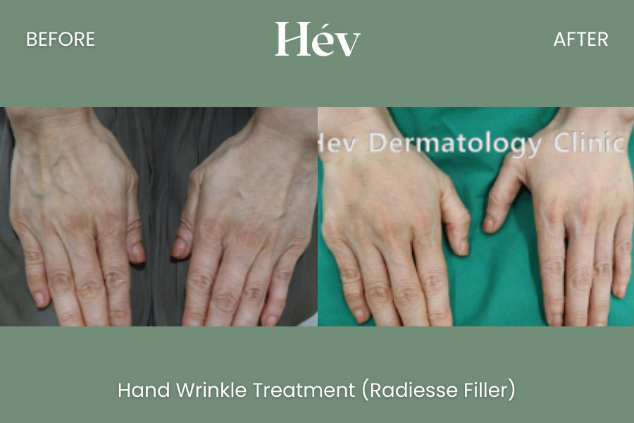hand-wrinkle-treatment before and after