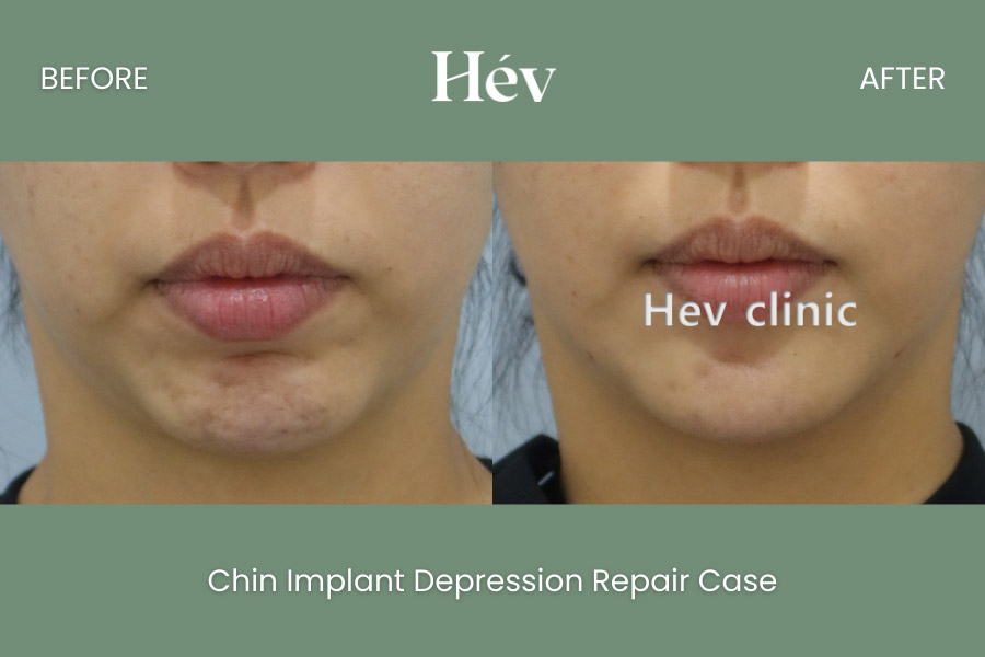 chin-implant-depression-repair-case