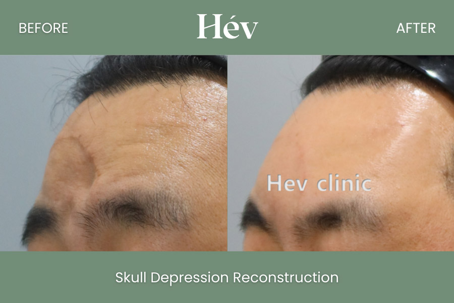 skull-depression-reconstruction