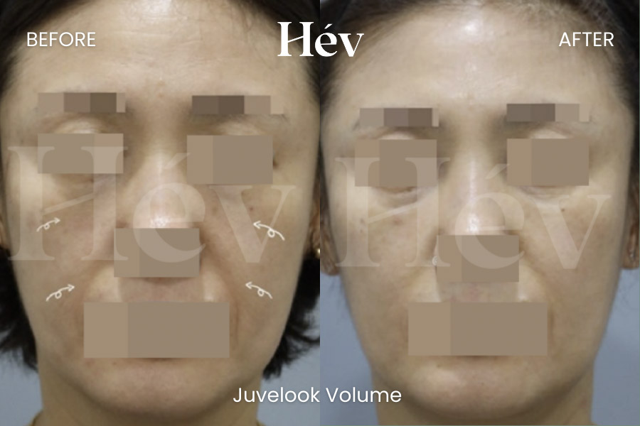 ATTACHMENT DETAILS Saved. juvelook-volume-smile-line-cheek-filler before and after