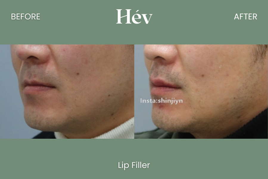 lip-filler before and after