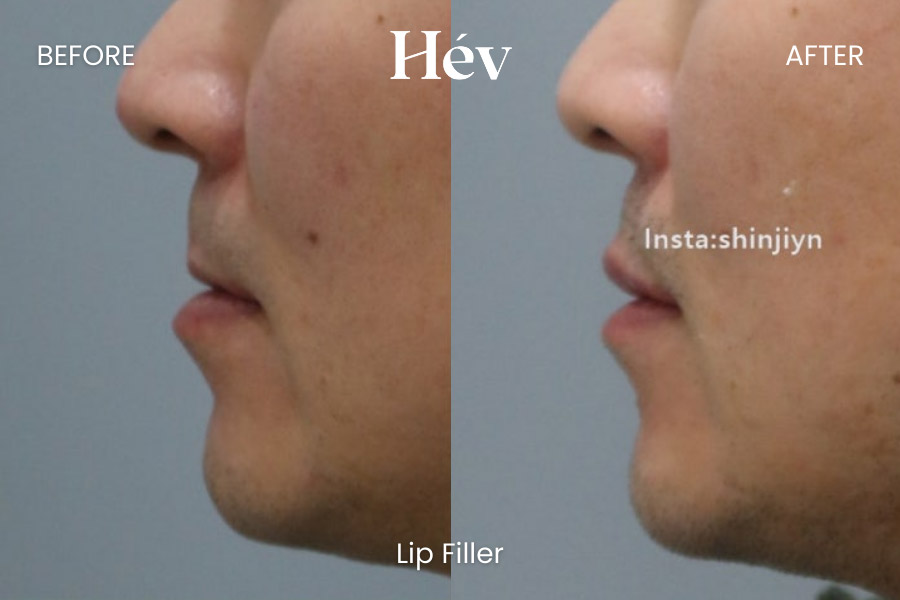 lip-filler before and after