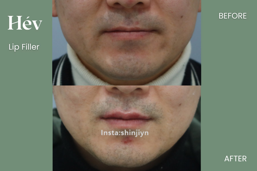 lip-filler before and after