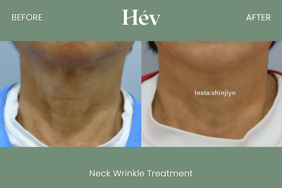 neck-wrinkle-treatment before and after