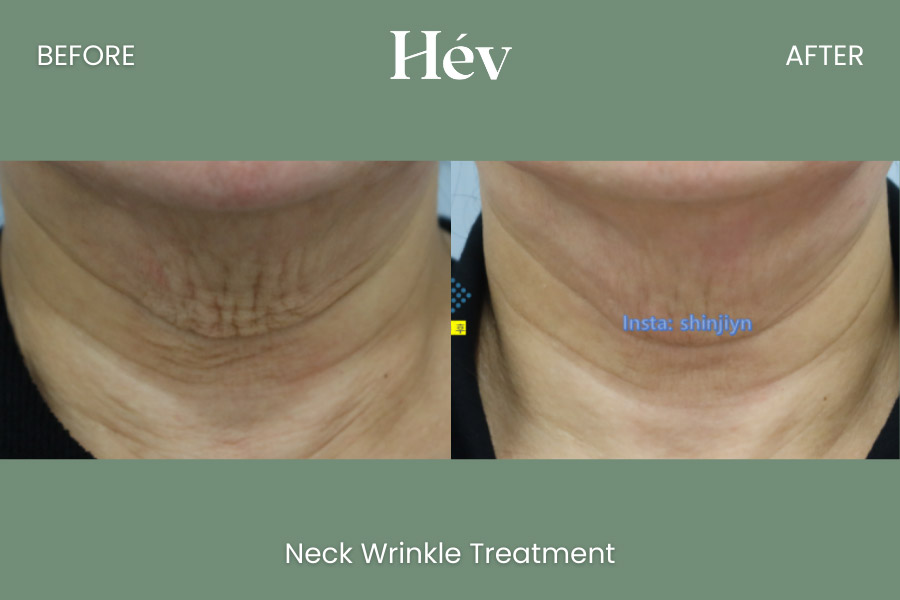 neck-wrinkle-treatment before and after