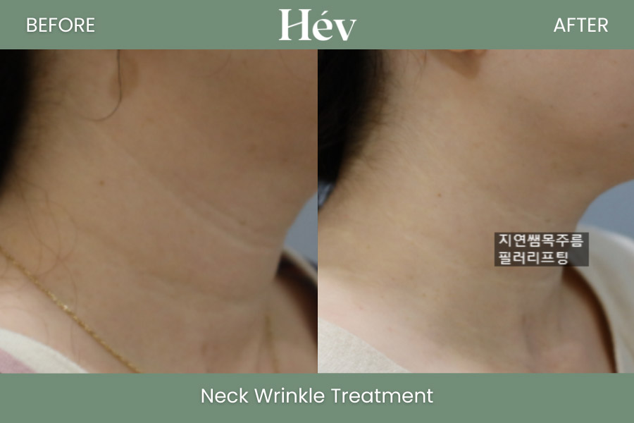neck-wrinkle-treatment before and after