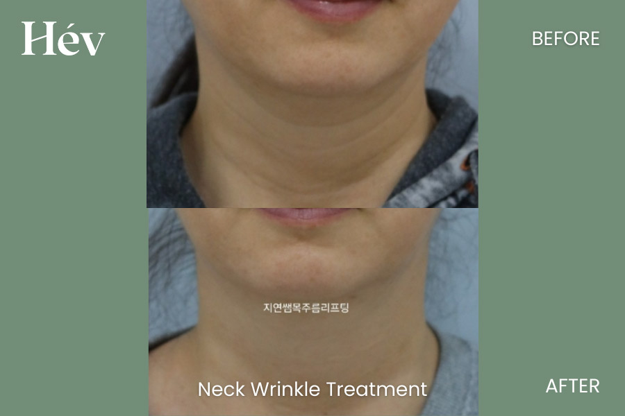 neck-wrinkle-treatment before and after