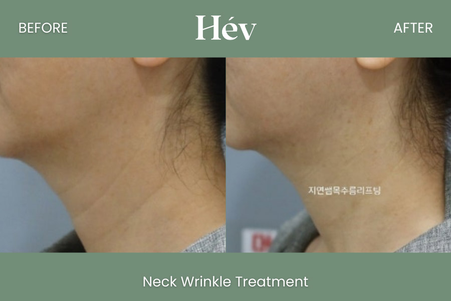 neck-wrinkle-treatment before and after