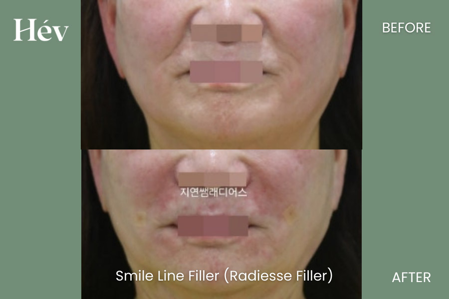 smile-line-filler before and after