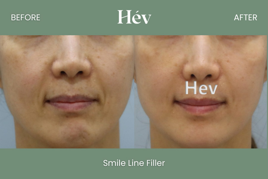 smile-line-filler before and after