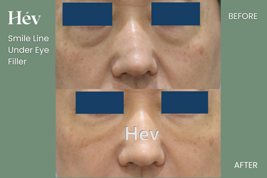 smile-line-under-eye-filler before and after