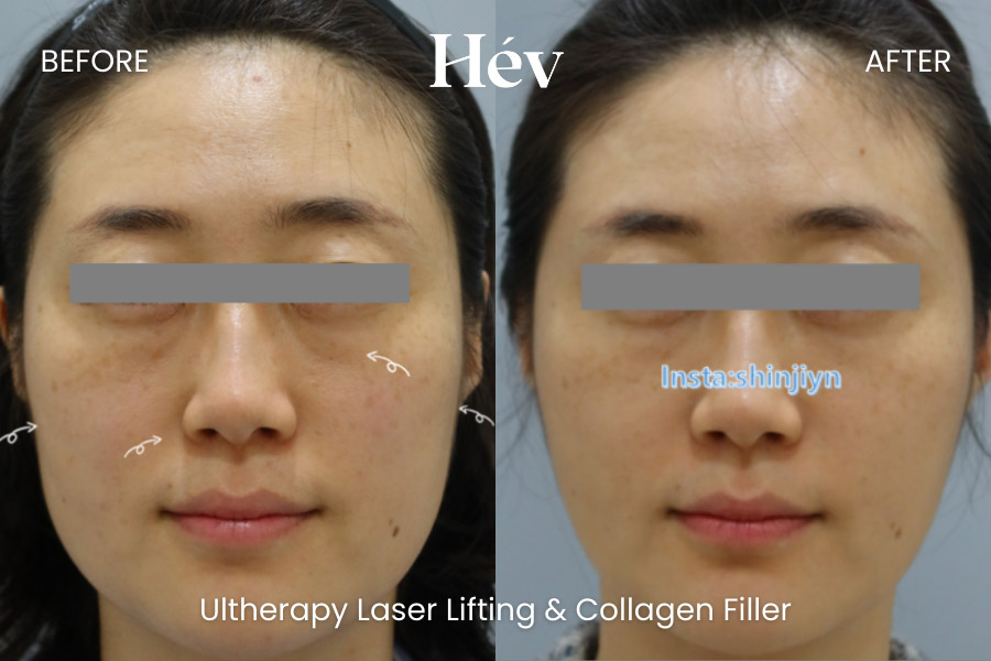 ultherapy-laser-lifting-collagen-filler before and after
