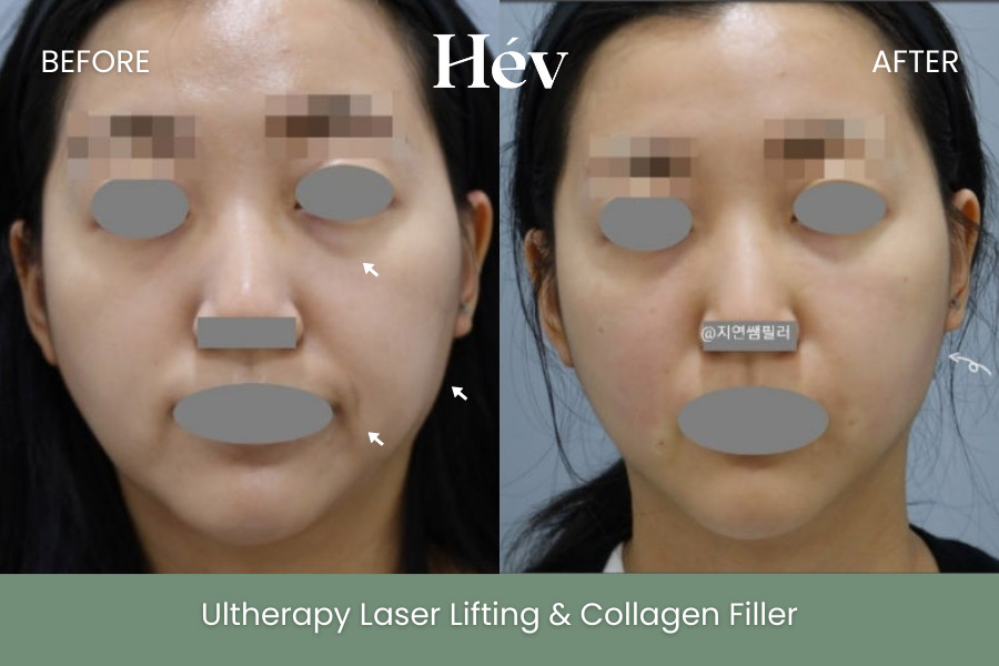 ultherapy-laser-lifting-collagen-filler before and after