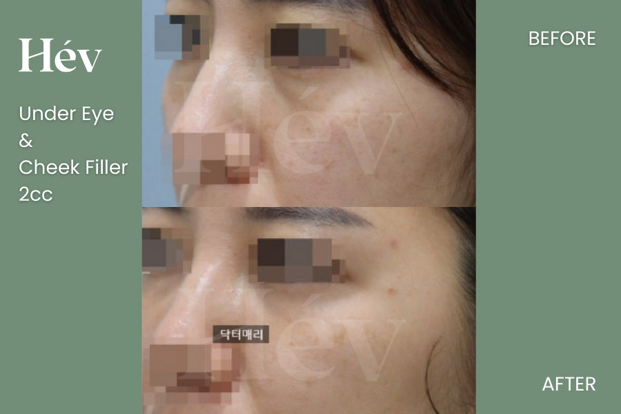 under-eye-cheek-filler before and after