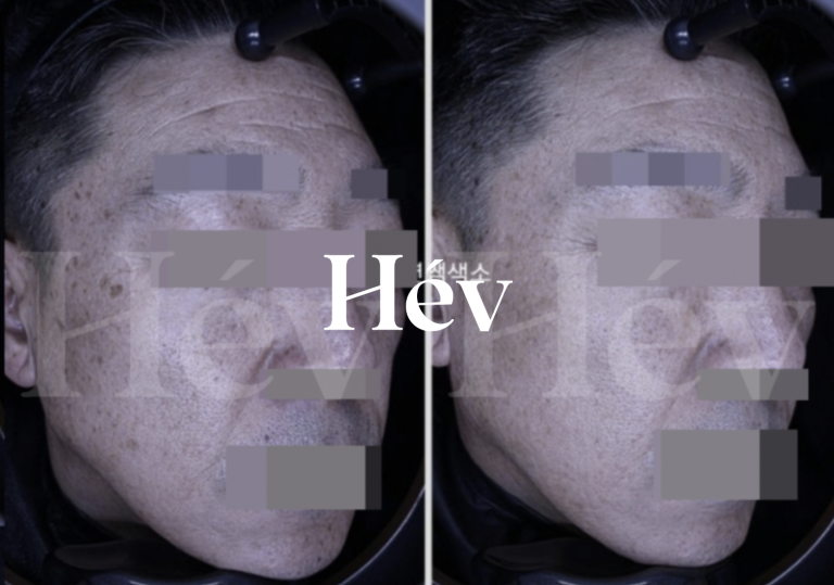 Review of Juvelook Volume Nasolabial Wrinkle Filler and Toning Laser Treatment for Freckles and Pigmentation