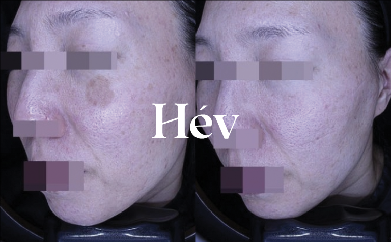 Add radiance to freckles, blemishes, and dark spots.