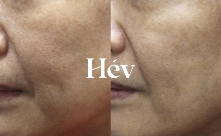 Thermage FLX and Oligio: treatment reviews and effects / an overview of radiofrequency laser treatments –