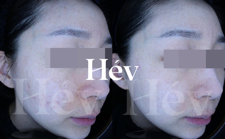 Before and After Reviews of Skin Booster Treatment for Freckles, Blackheads, and Pigmentation