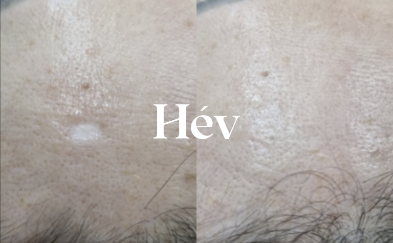 Laser treatment for stubborn chickenpox scars, gradually filling them with Cuberec.