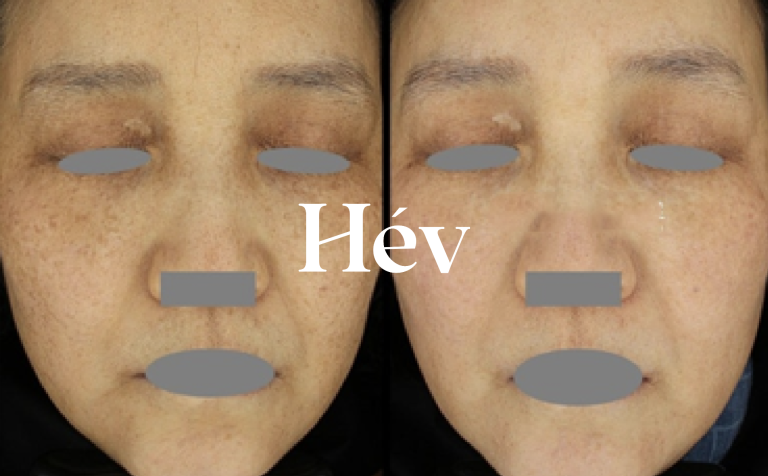 Freckle, dark spot, and pigmentation removal – Toning pigment laser before and after 10 and 20 sessions.
