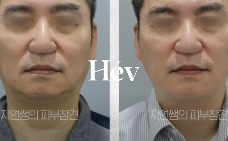 Double chin treatment for men in their 50s, Ulthera V-shaped chin, salivary gland botox, and lifting.