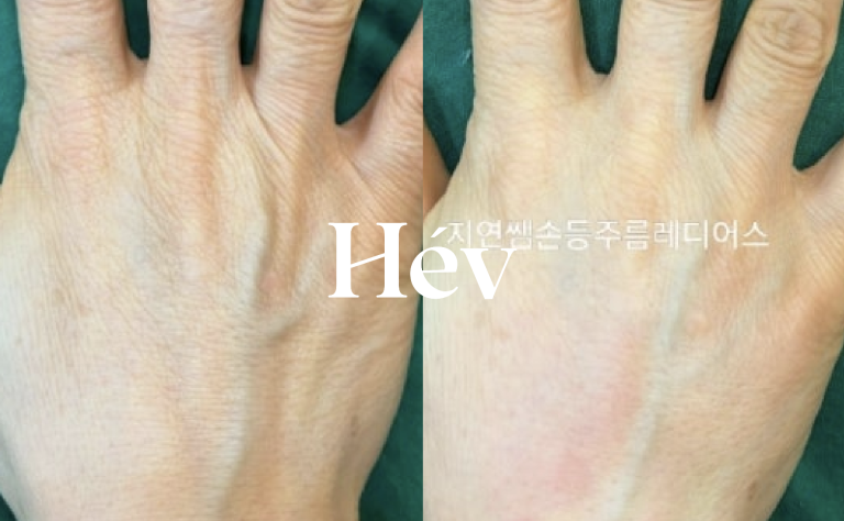 Radiesse lifting treatment to firm up wrinkled, crepey back-of-hand wrinkles without using filler.