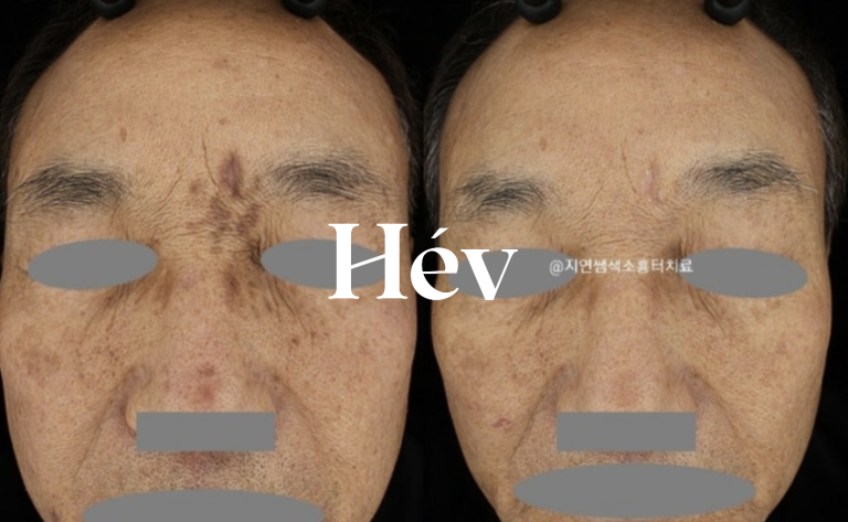 Shingles scar treatment – Laser and Juvederm stem cell regenerative injections.