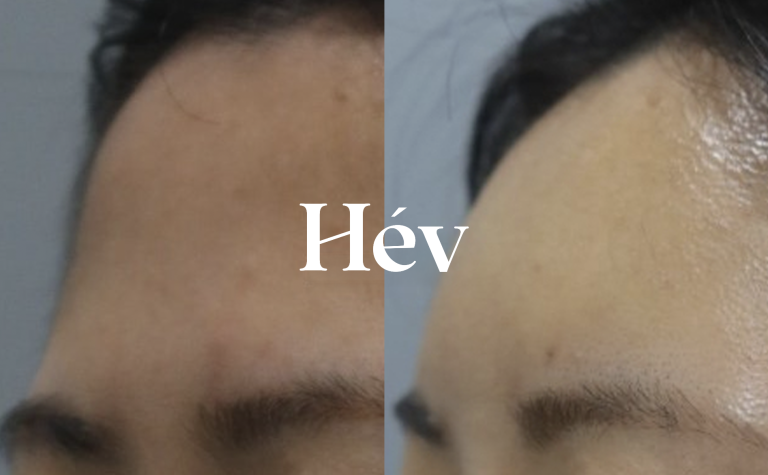 Review of 2.5cc forehead filler that feels like just 1cc of petite filler.