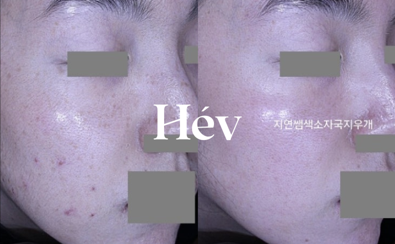 Dermatology treatment for acne scars, melasma, freckles, and pigmentation – 10 sessions of laser toning.