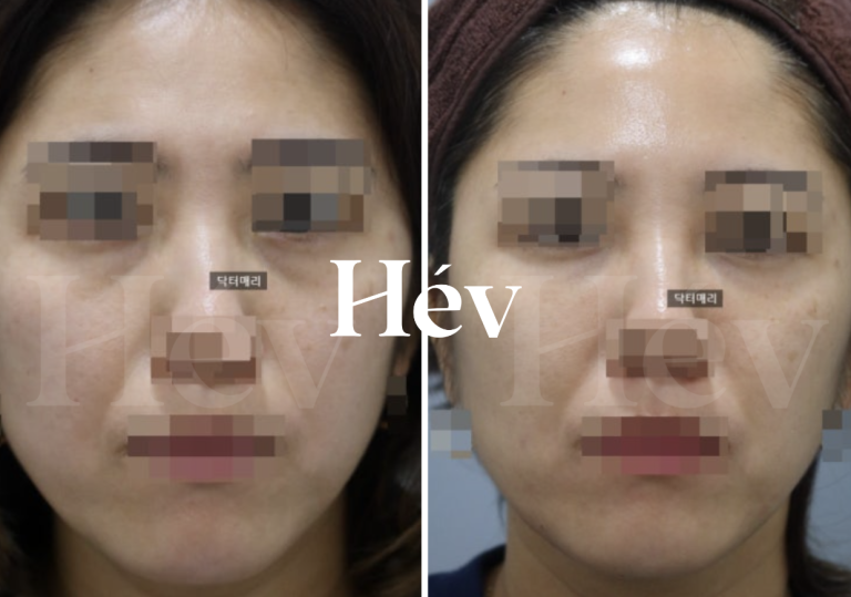 Under-Eye Hollowness & Anterior Cheek Filler (2cc) Review