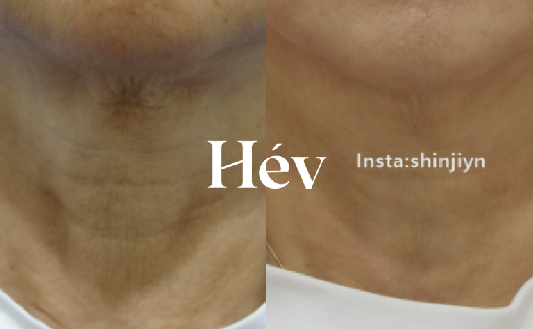 Fillers for neck wrinkles? Juvelook? Botox? Baby collagen injections?