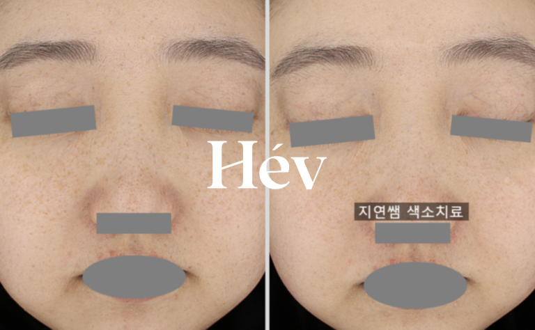 Pigmentation treatment for light melasma, freckles, and dark spots – 10 sessions.