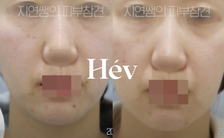 How to get Thermage or Ulthera for sunken areas without side effects?!