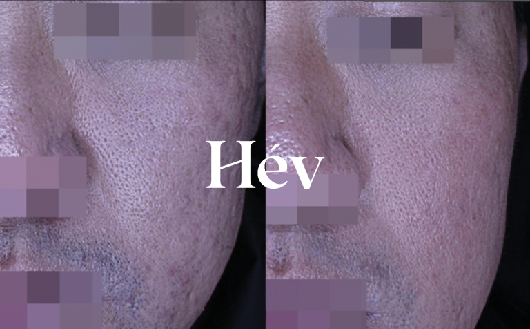 Acne scar + pores + skin elasticity treatment / CureJet + Juvederm Voluma + Potenza.