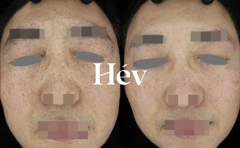 Progress and review of melasma, blemish, and pigmentation laser treatment.