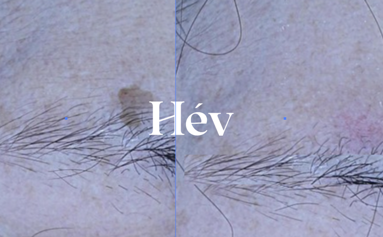 Incheon Dermatology: Laser Treatment for Dark Spots – Is It Possible for Dark Spots in the Eyebrows Too?