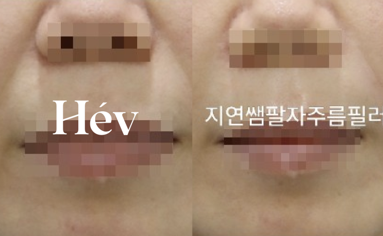 Nasolabial fold filler – 2ccBefore procedure vs. After procedure