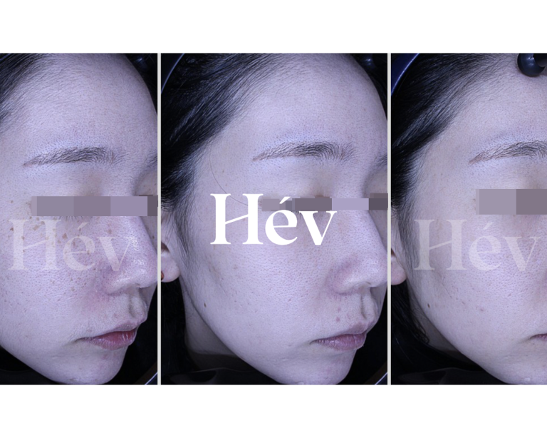 Why do the effects persist even after 10 sessions of pigment treatment + skin booster?