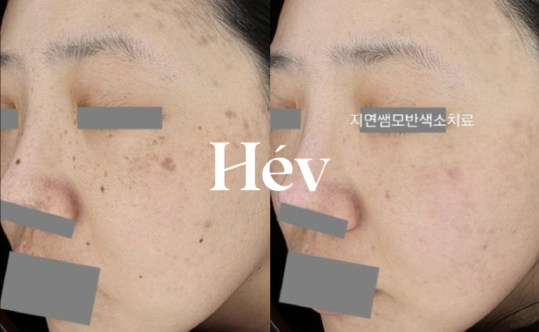 Acquired nevus, lentigines, melasma, and pigmentation treatment – 10 and 20 sessions, including Pico Toning, and their effects.