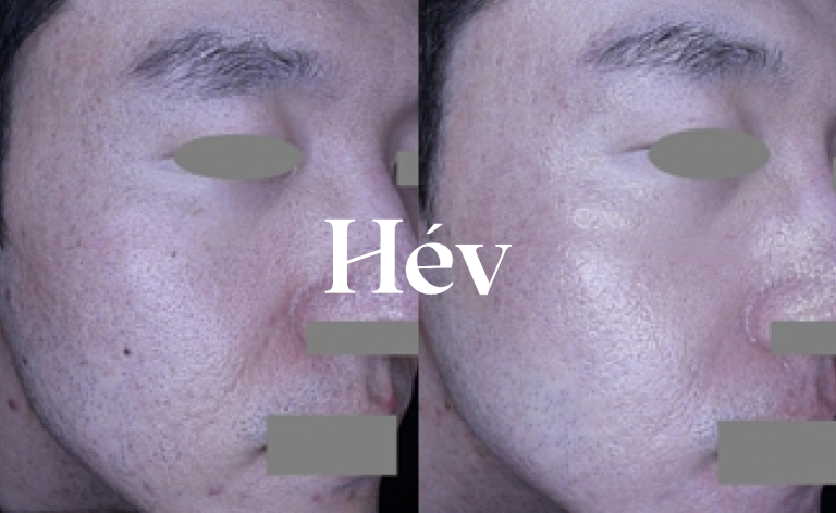 Men’s Skincare: A Review of Pigment Toning Laser & Juvelook Treatments for Melasma, Dark Spots, Pores, Radiance, and Skin Texture