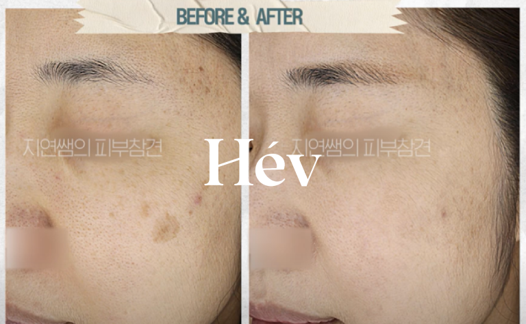 Before and after laser treatment for dark spots, melasma, and blemishes.