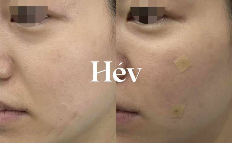 Juvederm Voluma self-treatment review: effects on front cheek hollowness and nasolabial folds.